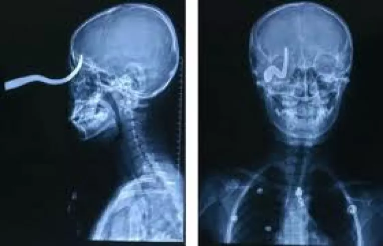 Dezbateri la televiziune cu oameni trepanati, fara creier, care au cip-uri implantate